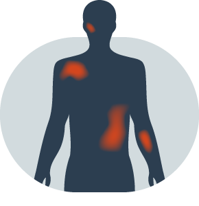 Acute Myeloid Leukemia - Intellia Therapeutics